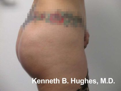 Butt Implants Before & After Patient #8147