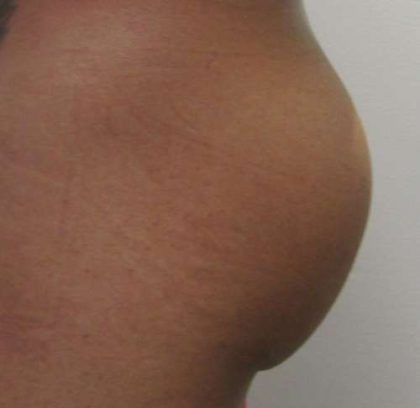 Butt Implants Before & After Patient #8186