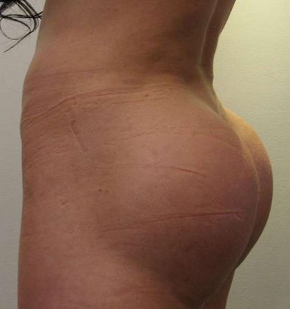 Butt Implants Before & After Patient #8193