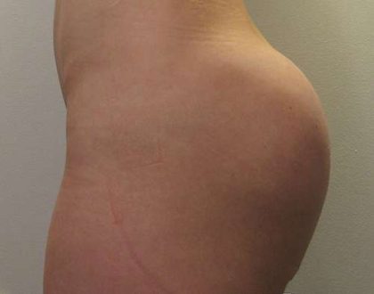 Butt Implants Before & After Patient #8198