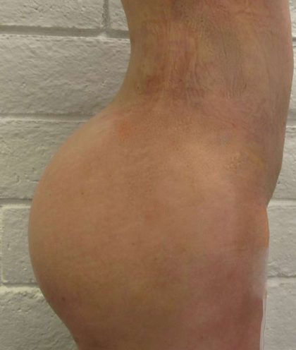 Butt Implants Before & After Patient #8219