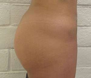 Butt Implants Before & After Patient #8224