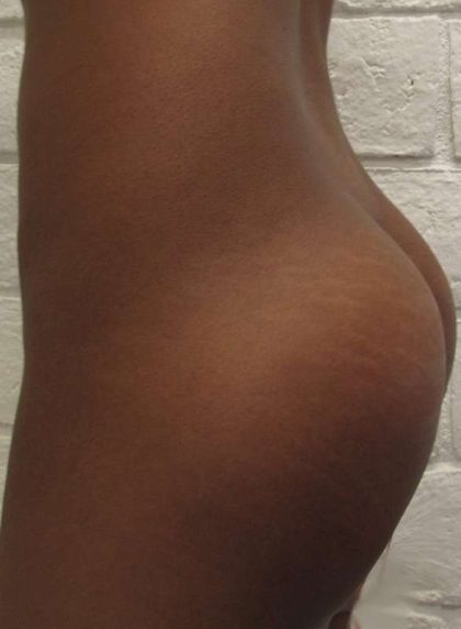 Butt Implants Before & After Patient #8241