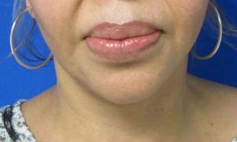 Chin Implant Before & After Patient #8307