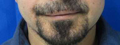 Chin Implant Before & After Patient #8312
