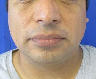 Chin Implant Before & After Patient #8317