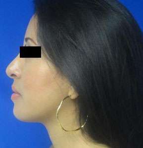Chin Implant Before & After Patient #8327
