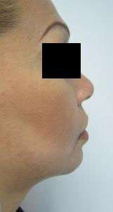 Chin Liposuction Before & After Patient #8340