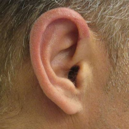 Ear Correction Before & After Patient #8373