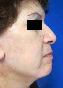 Facelift Before & After Patient #8492