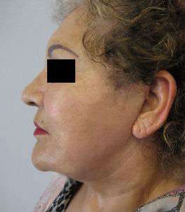 Facelift Before & After Patient #8508