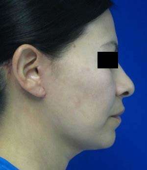 Facelift Before & After Patient #8522