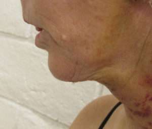 Facelift Before & After Patient #8527