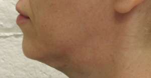 Facelift Before & After Patient #8534