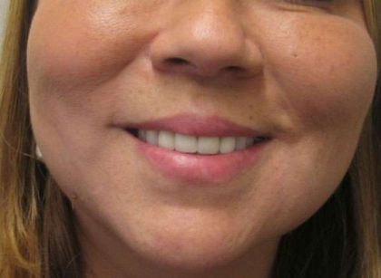 Facetite Before & After Patient #8546