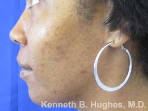 Facial Fat Grafting and Stem Cell Rejuvenation Before & After Patient #8554