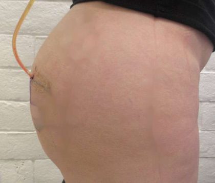 Fat Necrosis and Dead Fat Removal Before & After Patient #8586