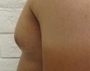 Gynecomastia Before & After Patient #8602
