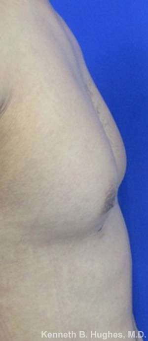 Gynecomastia Before & After Patient #8609