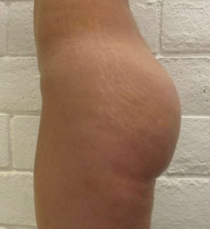 Liposuction Before & After Patient #8701