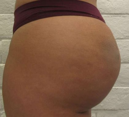 Liposuction Before & After Patient #8774
