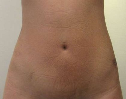 Liposuction Before & After Patient #8802