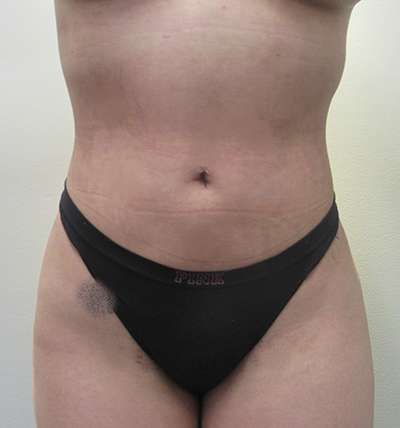 Liposuction Before & After Patient #8871