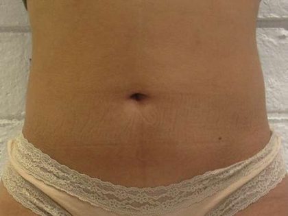 Liposuction Before & After Patient #8888
