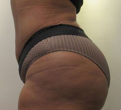 Liposuction Before & After Patient #8896