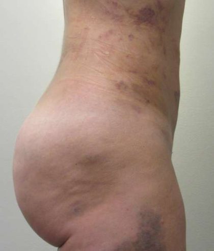 Liposuction Before & After Patient #8903