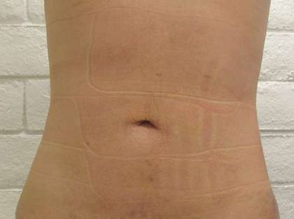 Liposuction Before & After Patient #8908