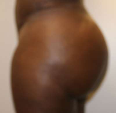 Liposuction Before & After Patient #8925
