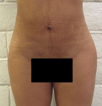 Liposuction Before & After Patient #8930