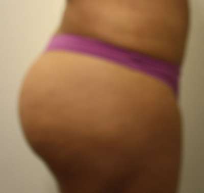 Liposuction Before & After Patient #8935