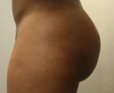 Liposuction Before & After Patient #8940