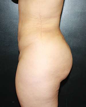Liposuction Before & After Patient #8948