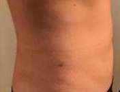 Bodytite Before & After Patient #6060