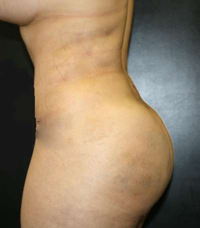 Liposuction Before & After Patient #8958