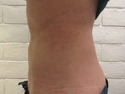 Bodytite Before & After Patient #6080