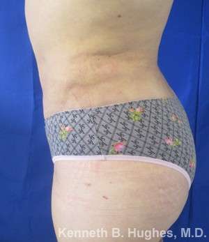 Liposuction Before & After Patient #9051