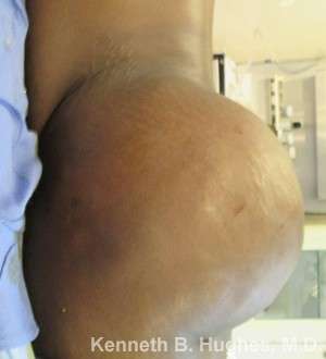 Liposuction Before & After Patient #9076