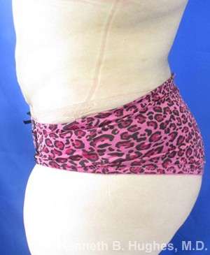 Liposuction Before & After Patient #9087