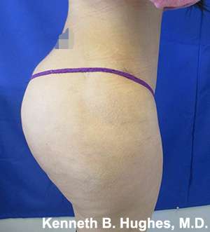 Liposuction Before & After Patient #9107