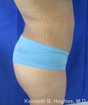 Liposuction Before & After Patient #9136
