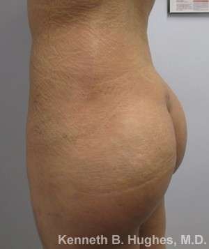 Liposuction Before & After Patient #9141