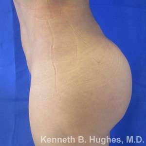Liposuction Before & After Patient #9167