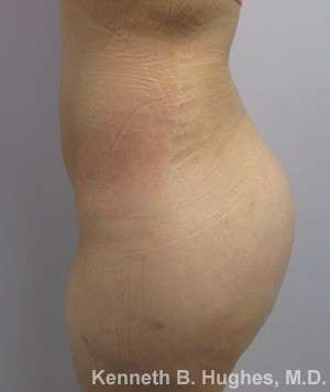 Liposuction Before & After Patient #9172