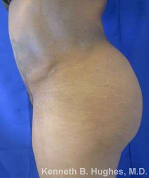 Liposuction Before & After Patient #9183
