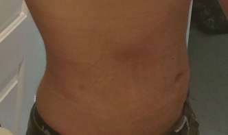 Bodytite Before & After Patient #6111
