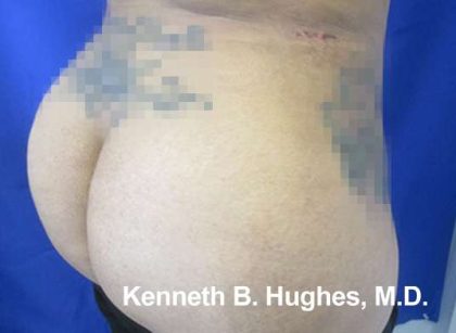 Liposuction Before & After Patient #9204